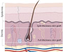 نتیجه جستجوی لغت [graft] در گوگل