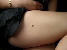 Bei einem rein kosmetischen eingriff muss der patient den eingriff selbst bezahlen. Leberfleck Ursachen Beschwerden Diagnose Behandlung Prognose Vorbeugung Gesundmed Medizin Und Gesundheit Im Web