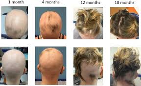 Ancak, bazı tedaviler bazı insanların saçlarını yeniden. Experience With Oral Tofacitinib In 8 Adolescent Patients With Alopecia Universalis Journal Of The American Academy Of Dermatology