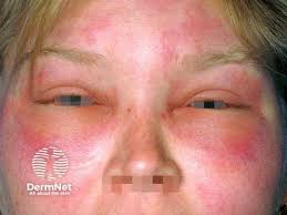 Image result for Angioedema
