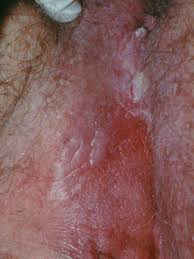 Image result for genital warts