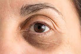 Geschwollene Augen Wie Man Angeschwollene Augen Loswird