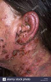 Herpes Zoster Infektion Von Der Linken Seite Des Gesichts Und Der Ohren Stockfotografie Alamy