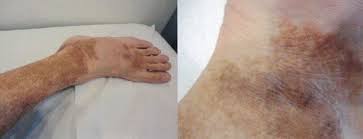 Senile purpura, also known as solar purpura, affects older individuals who have thinner skin and more fragile blood vessels.while it looks concerning, this type of purpura is usually mild and resolves on its own. Acd A Z Of Skin Pigmented Purpuric Dermatosis