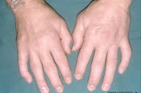 What are the 5 types of psoriatic arthritis. What Questions Should I Ask About Psoriatic Arthritis