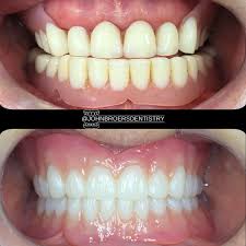 Image result for dentures