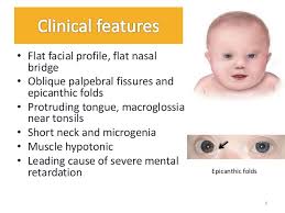 Medical conditions that cause the nasal bridge not to develop and project are also associated with epicanthic fold. Down S Syndrome And Klinefelter S Sundrome