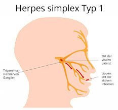 Herpes Simplex Ansteckung Symptome Behandlung