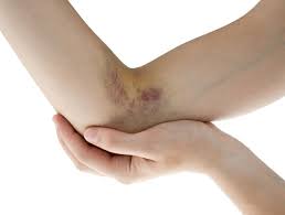 Purpura in the elderly is caused by many factors, but the major issues that promote this are: Actinic Purpura Meridian Boise Id Boise Dermatology Dr Brooks