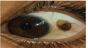Image result for nevus sclerae