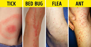 Silver dollar, with legs outstretched. How To Identify A Bug Bite And What To Do With It