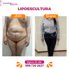 Lipoescultura, Antes y Después...