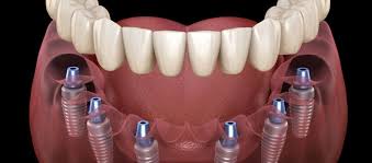All-on-6 Dental Implants - Procedure | Benefits | Need | Cost ...