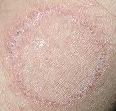 Ringworm Treatment Dermatology Care Of Charlotte Dermatology Care Of Charlotte Ringworm is not actually caused by worms — it's a fungal infection. ringworm treatment dermatology care