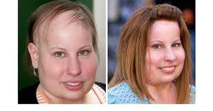 Caroline » Best Non-Surgical Hair Replacement in Chennai, Coimbatore,  London, SrilankaBest Non-Surgical Hair Replacement in Chennai, Coimbatore,  London, Srilanka