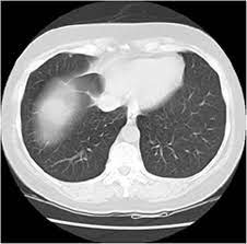 If you are a smoker, it is highly recommended to have a ct scan every 3 months. Effective And Reliable Framework For Lung Nodules Detection From Ct Scan Images Scientific Reports