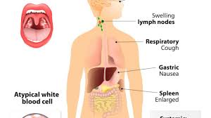 Most people are infected by the virus as children, when the disease produces few or no symptoms. Opportunistische Infecties Bij Lyme Pfeiffer Lymeherstel