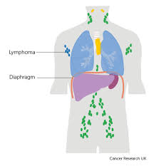 It can also form in the lymph nodes and other organs, such as the stomach, intestines, and skin. Stages Of Non Hodgkin Lymphoma Non Hodgkin Lymphoma Cancer Research Uk