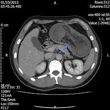 Image result for Adult Intussusception
