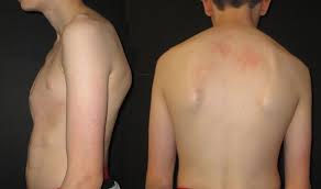 Why does a bone in the back of neck stick out. Pectus Posture Pectus Clinic