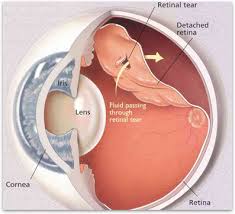 A retinal detachment is a serious issue, and it's essential to. Retinal Detachment Retina Vitreous Surgeons Of Cny