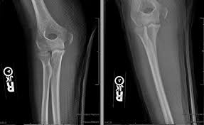 Last ossification center to fuse in distal humerus. Medial Epicondyle Nonunions In Children Case Report With Overview And Management Abstract Europe Pmc