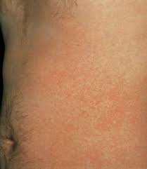 Image result for sweat rash on back