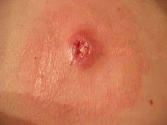 Ingrown hair on penile shaft: Ingrown Hair Ingrown Hair On My Shaft