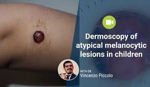 Image result for Dermoscopy
