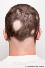 The aad notes that hair shedding—or temporarily losing a little more hair than usual—is completely normal, and usually occurs after a major life stressor or body change, like losing 20 pounds or. Hair Loss Symptom Evaluation