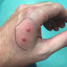My hand was on fire': Snake bite turned dad's hand purple after he found 15  serpents in garden - Mirror Online