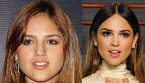 Quieres saber en qué consiste la operación de bichectomia. 10 Famosos Con Bichectomia Antes Y Despues Dr Edwin Vasquez