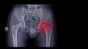 Image result for Hip XRay