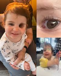 The most successful surgery in the world ❤ This beautiful girl is seen  after repair of her bilateral cleft lip and palate. The orbicularis oris  muscle normally completes a ring around the