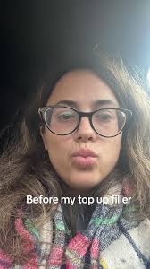 Faye Lips Before and After