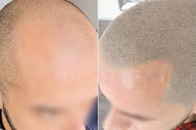 La micro pigmentazione, conosciuta anche come trucco permanente o semipermanente, è una specialità estetica che prevede l'introduzione nella cute, per mezzo di . Pigmentazione Tricologica