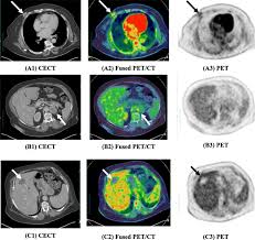 Right now, ct scans are not used routinely to evaluate the breast. Role Of Positron Emission Tomography Computed Tomography Pet Ct In Breast Cancer Egyptian Journal Of Radiology And Nuclear Medicine Full Text