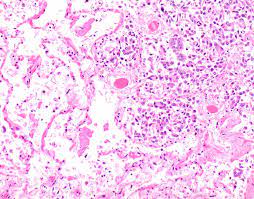 Pathol res pract.2016 the fake fat phenomenon in organizing pleuritis: Pathology Outlines Diffuse Malignant Mesothelioma