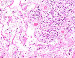 Check spelling or type a new query. Pathology Outlines Diffuse Malignant Mesothelioma