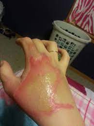 I Fucking Burned My Skin Off Album On Imgur