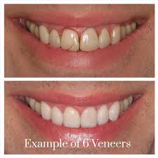 Porcelain Veneers Sydney Dental Veneers Sydney Teeth Veneers
