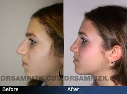 Before And After Photo Of A 14 Year Old Female Teenager Who Had Rhinoplasty Nose Job Rhinoplasty Nose