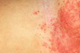 Leucemia manchas rojas en la piel. Que Causa Manchas Rojas En Las Piernas El Blog De La Salud Tu Blog De Salud Bienestar Y Nutricion