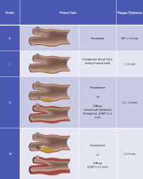 The right and left subclavian arteries give rise to the thyrocervical trunk. Recommendations For The Assessment Of Carotid Arterial Plaque By Ultrasound For The Characterization Of Atherosclerosis And Evaluation Of Cardiovascular Risk From The American Society Of Echocardiography Journal Of The American Society