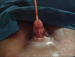 Résultat de recherche d'images pour "penis degloved"