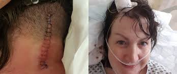 Pain from little-known brain condition left me feeling like my head was  being ripped off"