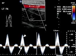 color and pulsed wave doppler sonograms of normal lower