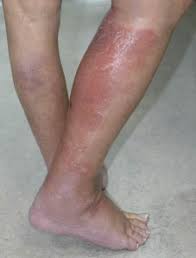 Citrobacter Koseri Cellulitis During Anti Cd20 Monoclonal Antibody Ofatumumab Treatment For B Cell Chronic Lymphocytic Leukaemia Html Acta Dermato Venereologica