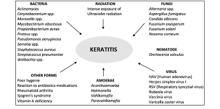 The treatment of hsv keratitis usually involves medicine, including eye drops or antiviral medications taken by mouth 4. Major Categories Of Corneal Inflammation Keratitis Of Eyes Download Scientific Diagram