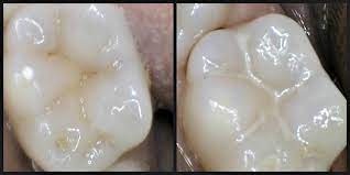 Maybe you would like to learn more about one of these? What Is A Sealant And Why Does My Tooth Need It